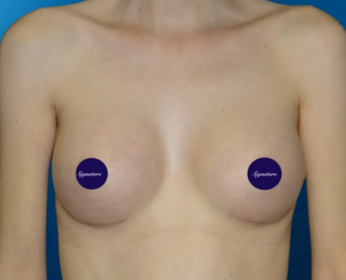 Breast Augmentation 1 After