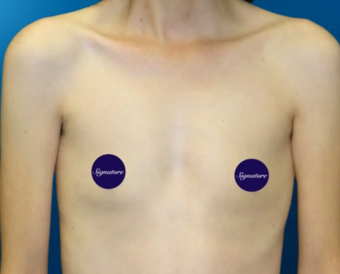 Breast Augmentation 1 Before