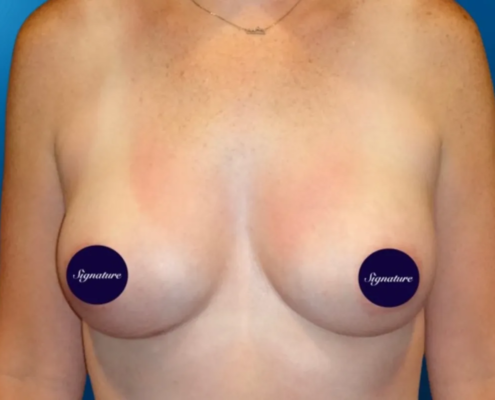 Breast Augmentation 10 After