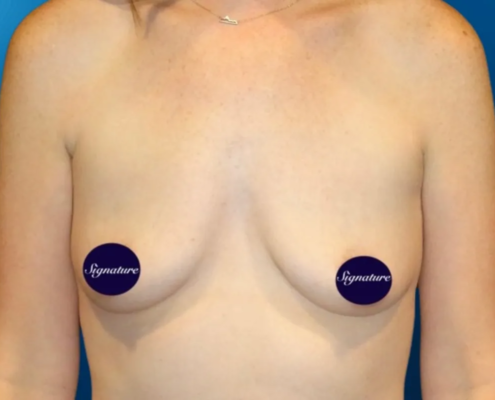 Breast Augmentation 10 Before