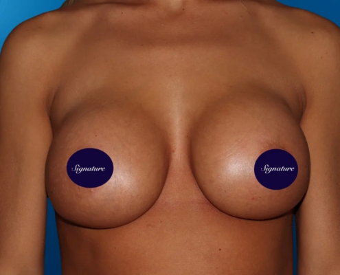 Breast Augmentation 11 After