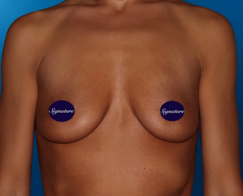 Breast Augmentation 11 Before
