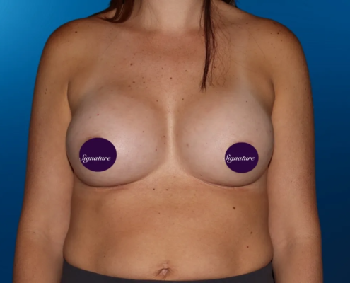 Breast Augmentation 14 After