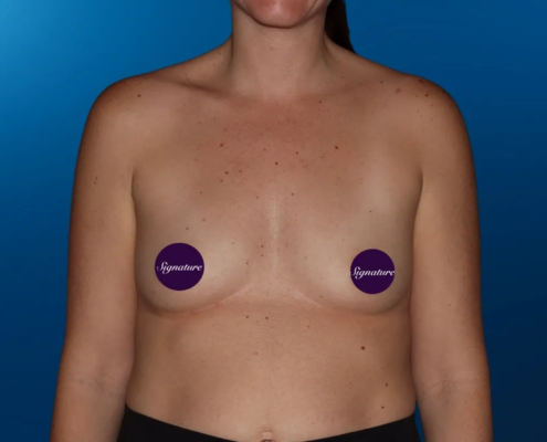Breast Augmentation 14 Before