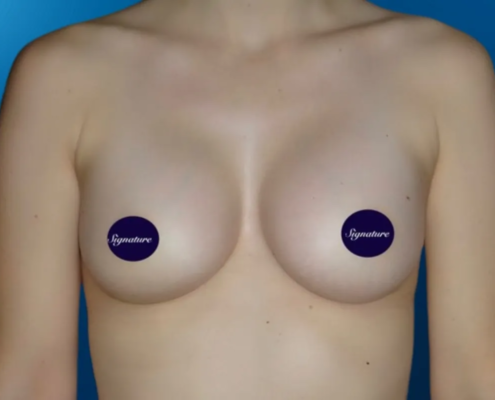 Breast Augmentation 2 After