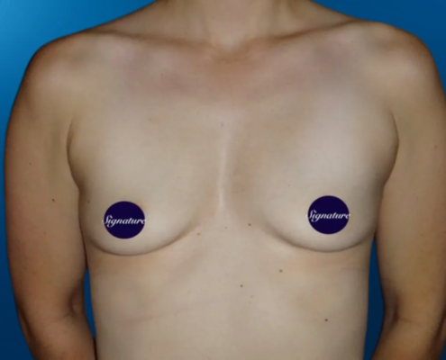 Breast Augmentation 2 Before