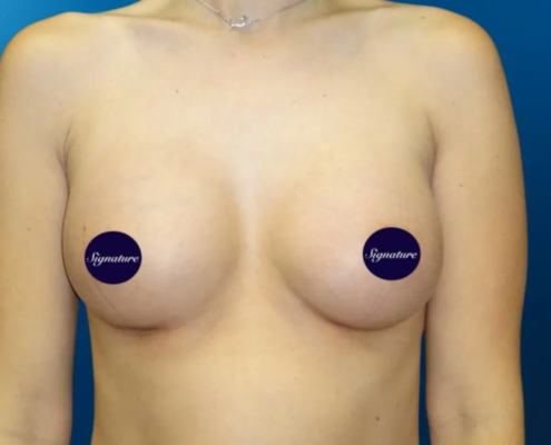 Breast Augmentation 3 After