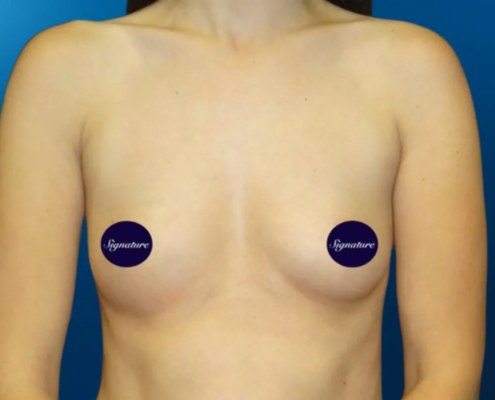 Breast Augmentation 3 Before