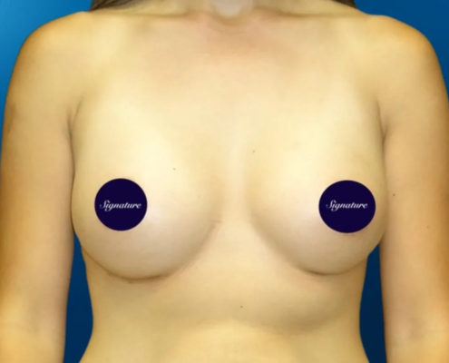 Breast Augmentation 4 After