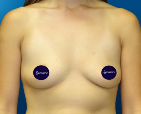 Breast Augmentation 4 Before