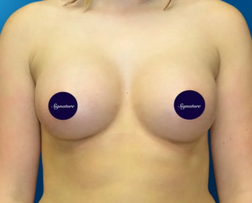 Breast Augmentation 5 After