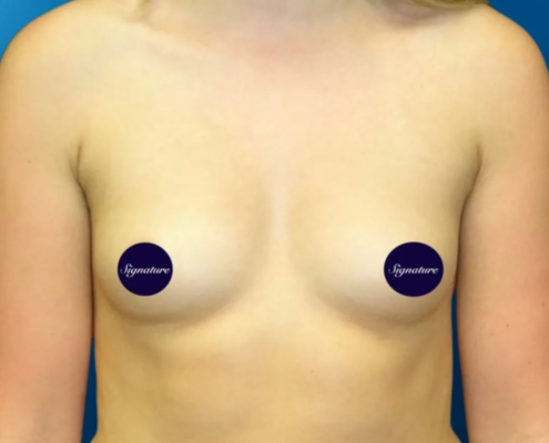 Breast Augmentation 5 Before