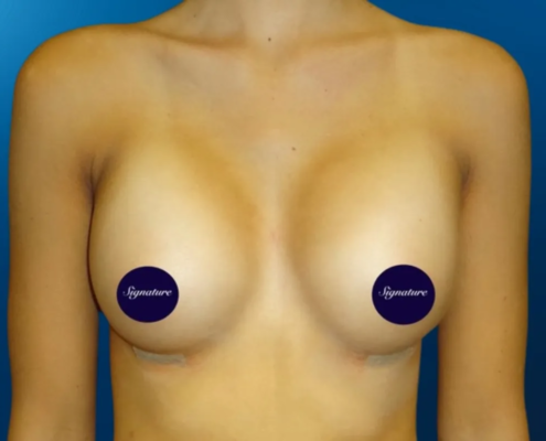 Breast Augmentation 9 After