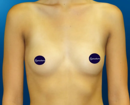 Breast Augmentation 9 Before