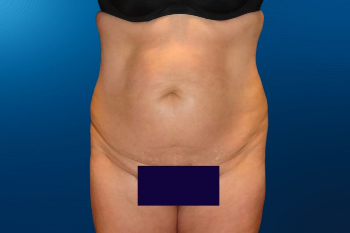 Abdominoplasty 10A