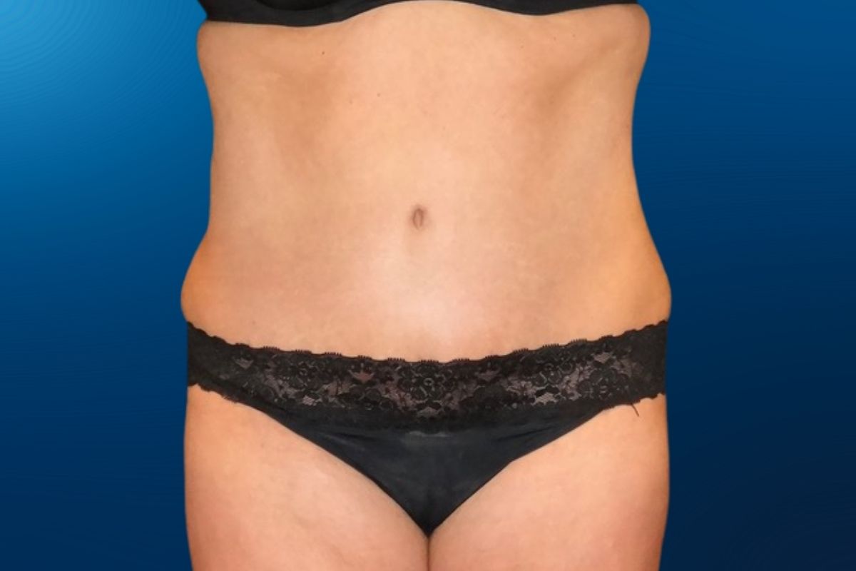Abdominoplasty 10B