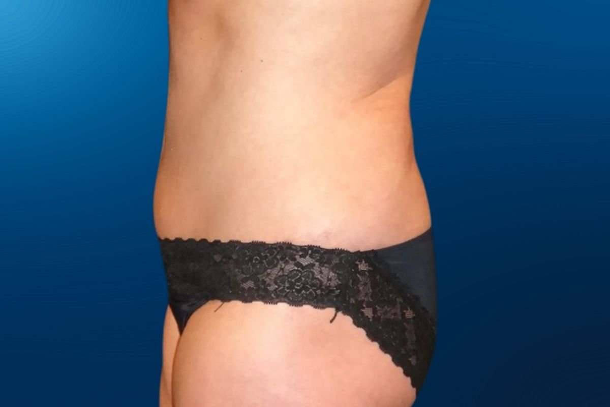Abdominoplasty 10D