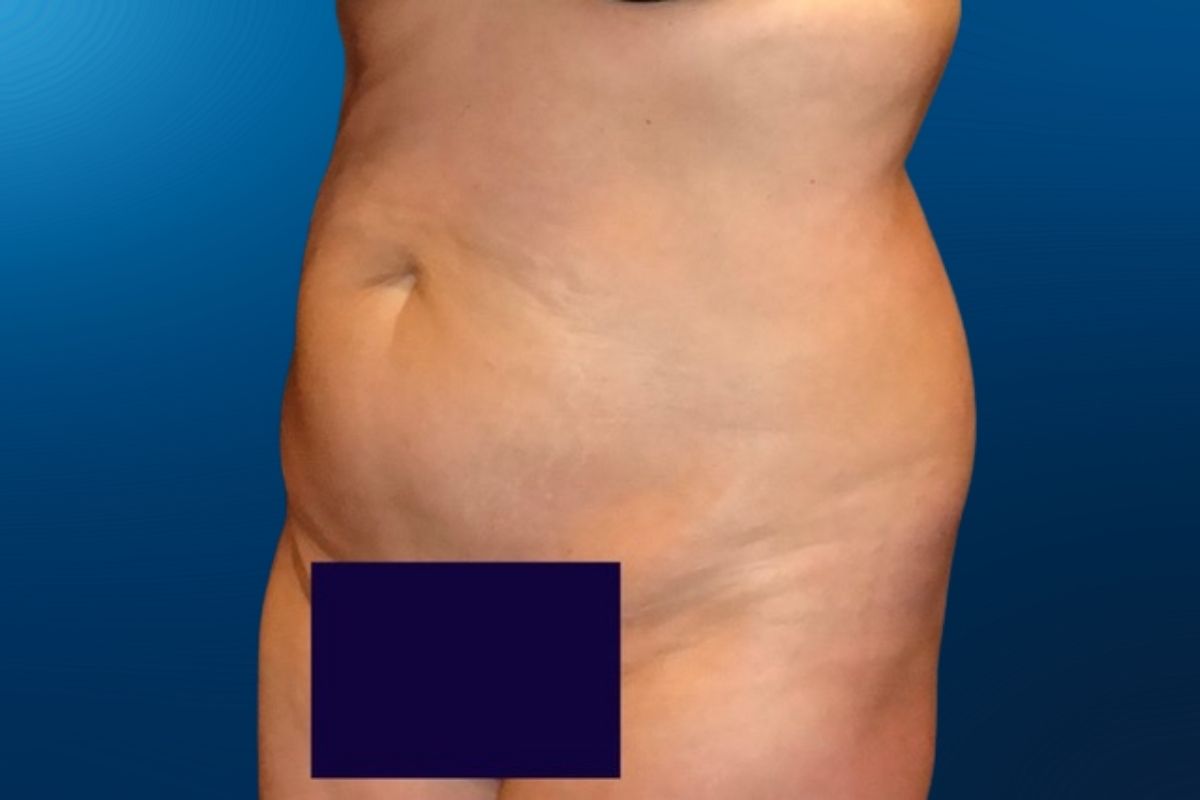 Abdominoplasty 10E