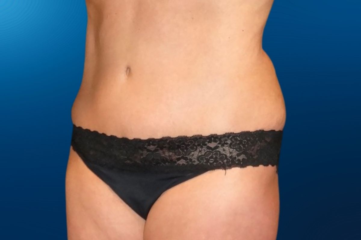Abdominoplasty 10F