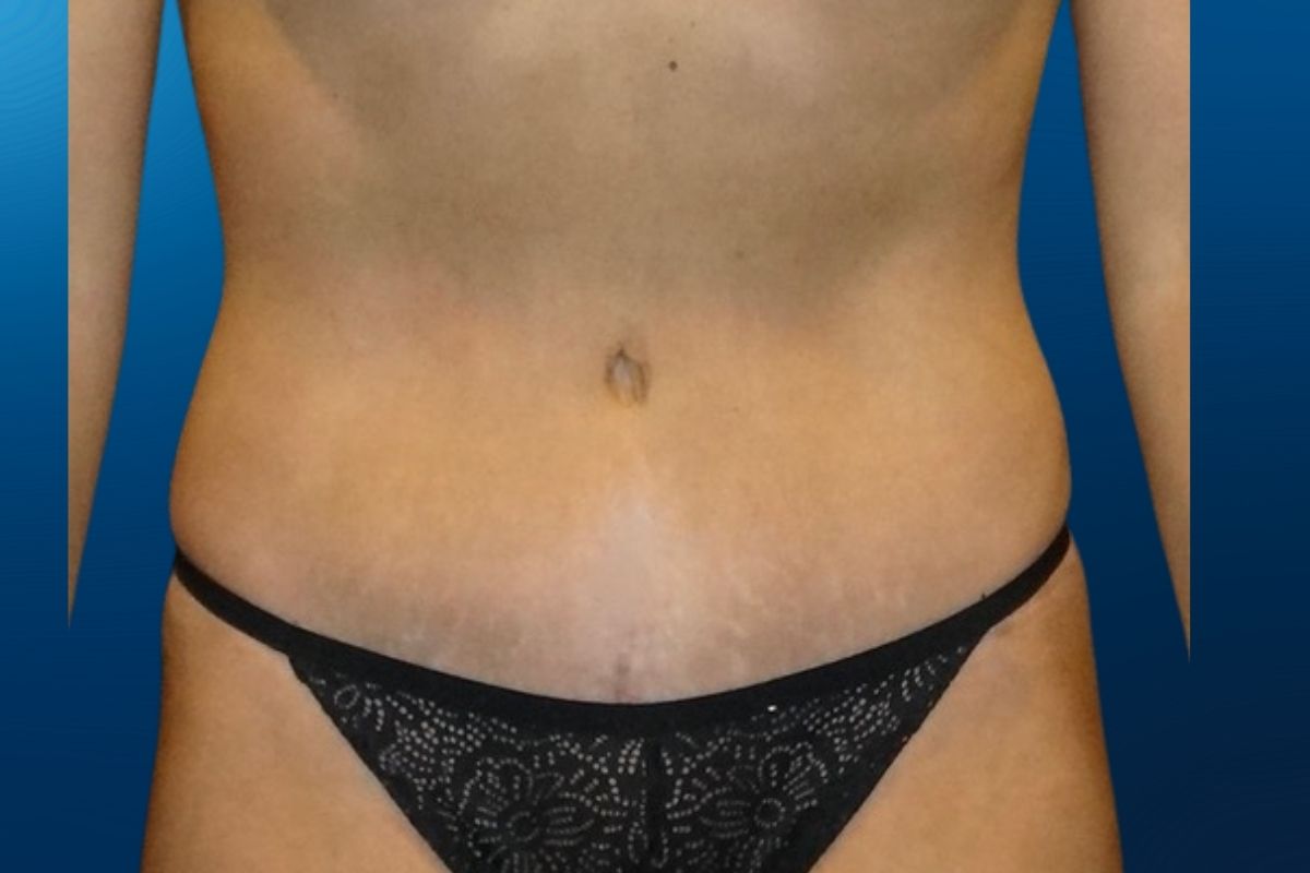 Abdominoplasty 11B