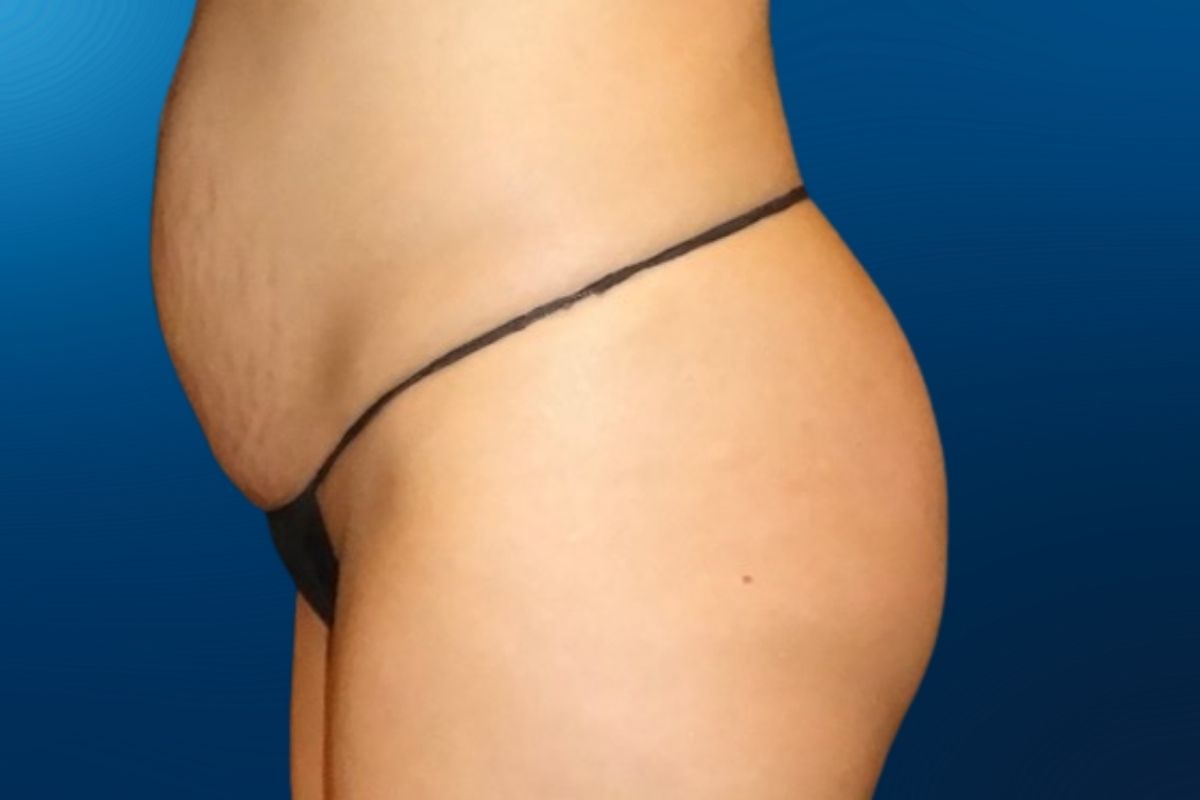 Abdominoplasty 11C