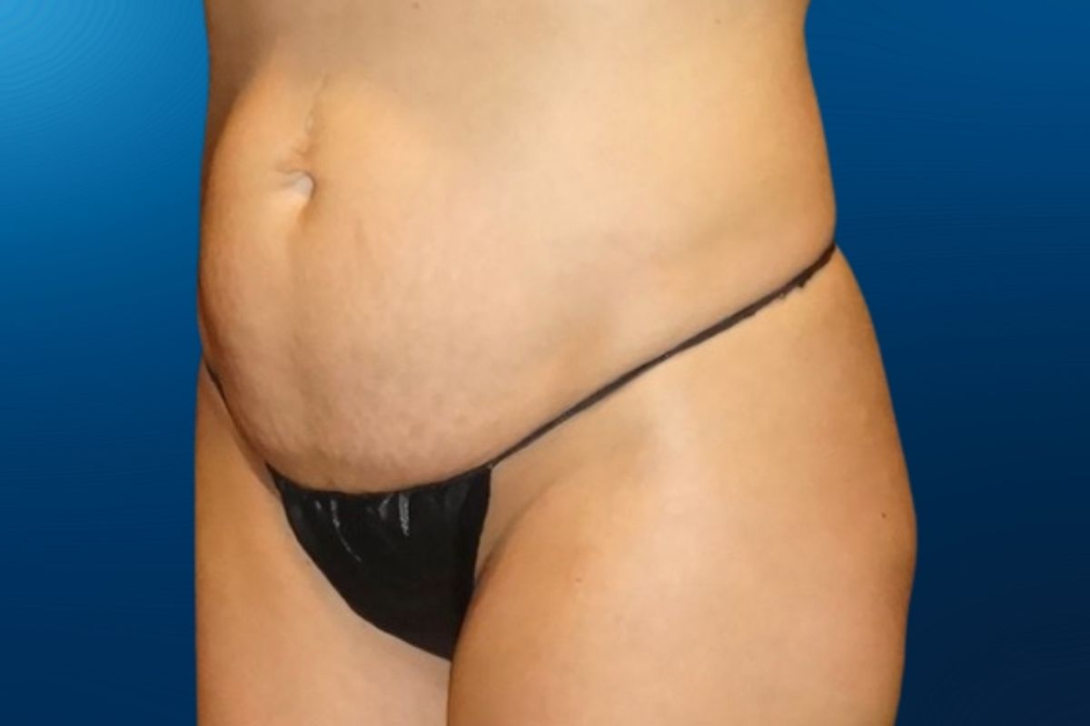 Abdominoplasty 11E