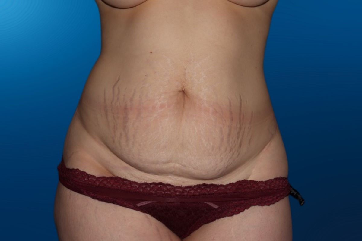 Abdominoplasty 12A
