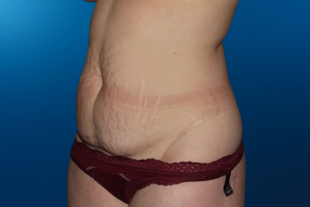 Abdominoplasty 12C