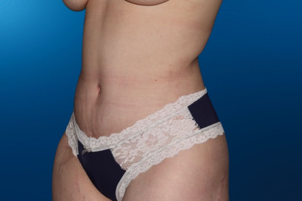 Abdominoplasty 12D
