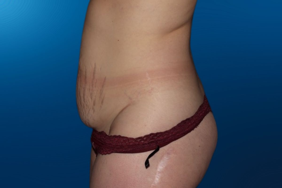 Abdominoplasty 12E
