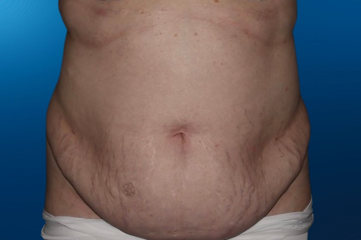 Abdominoplasty 13A
