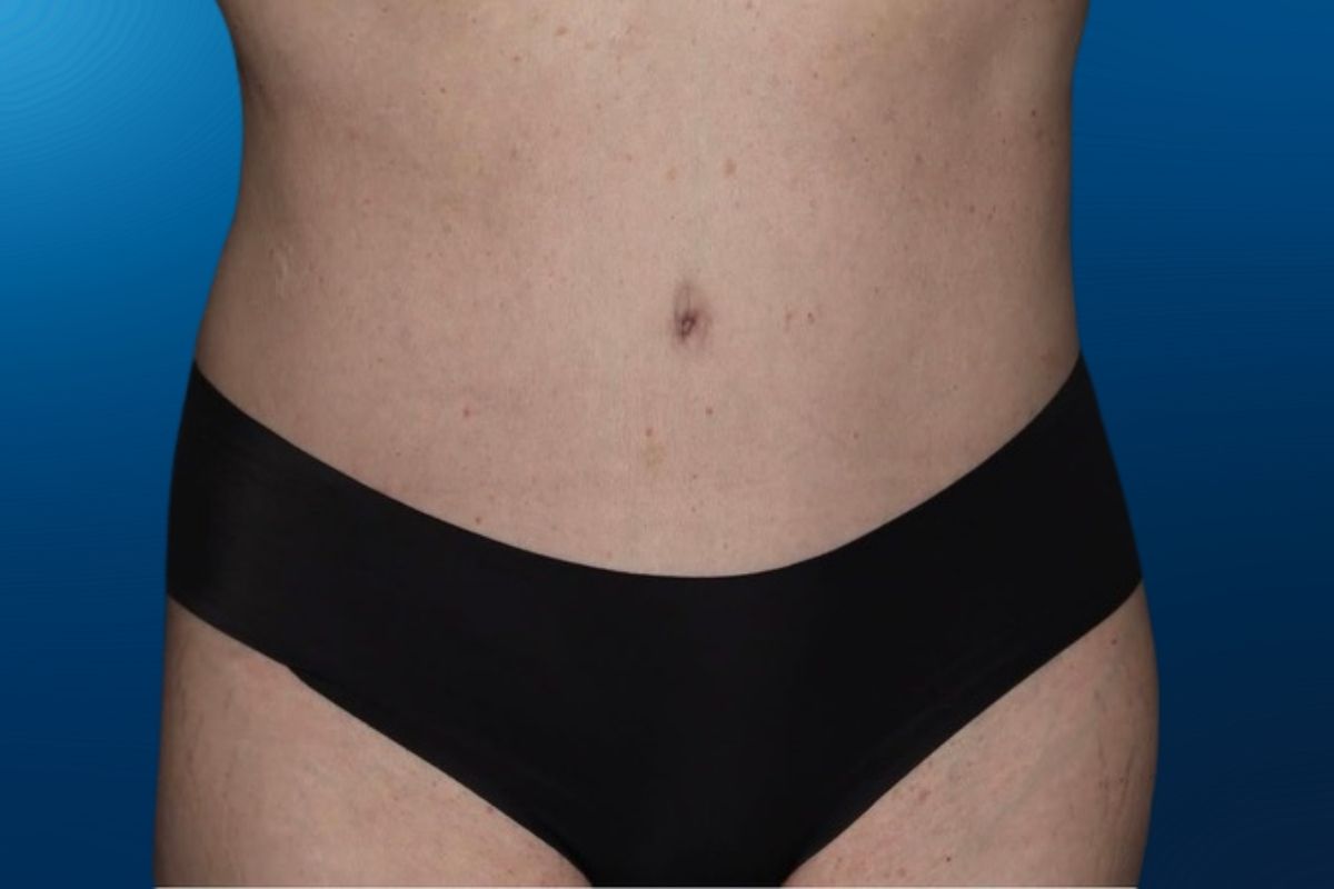 Abdominoplasty 13B