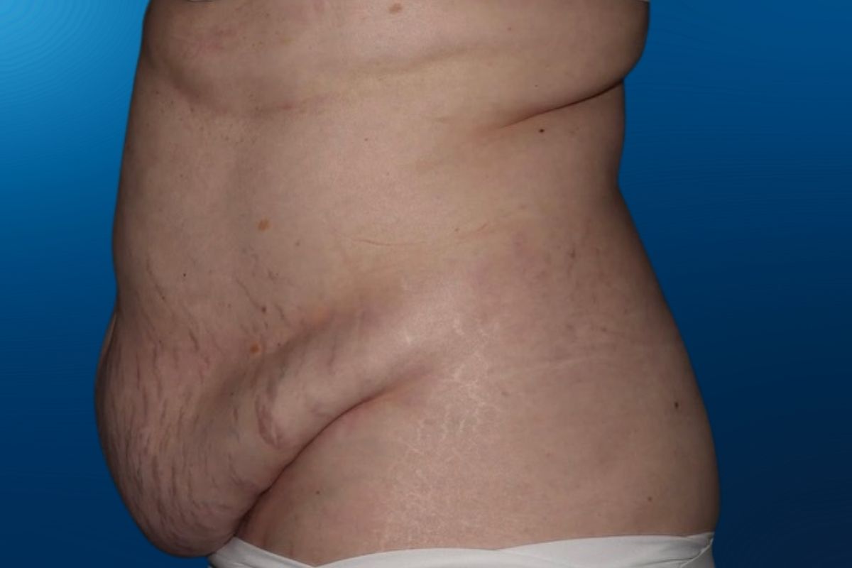 Abdominoplasty 13C