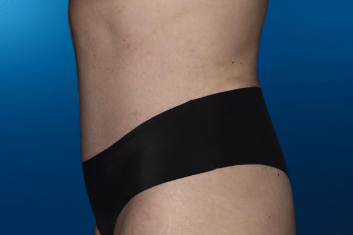 Abdominoplasty 13D