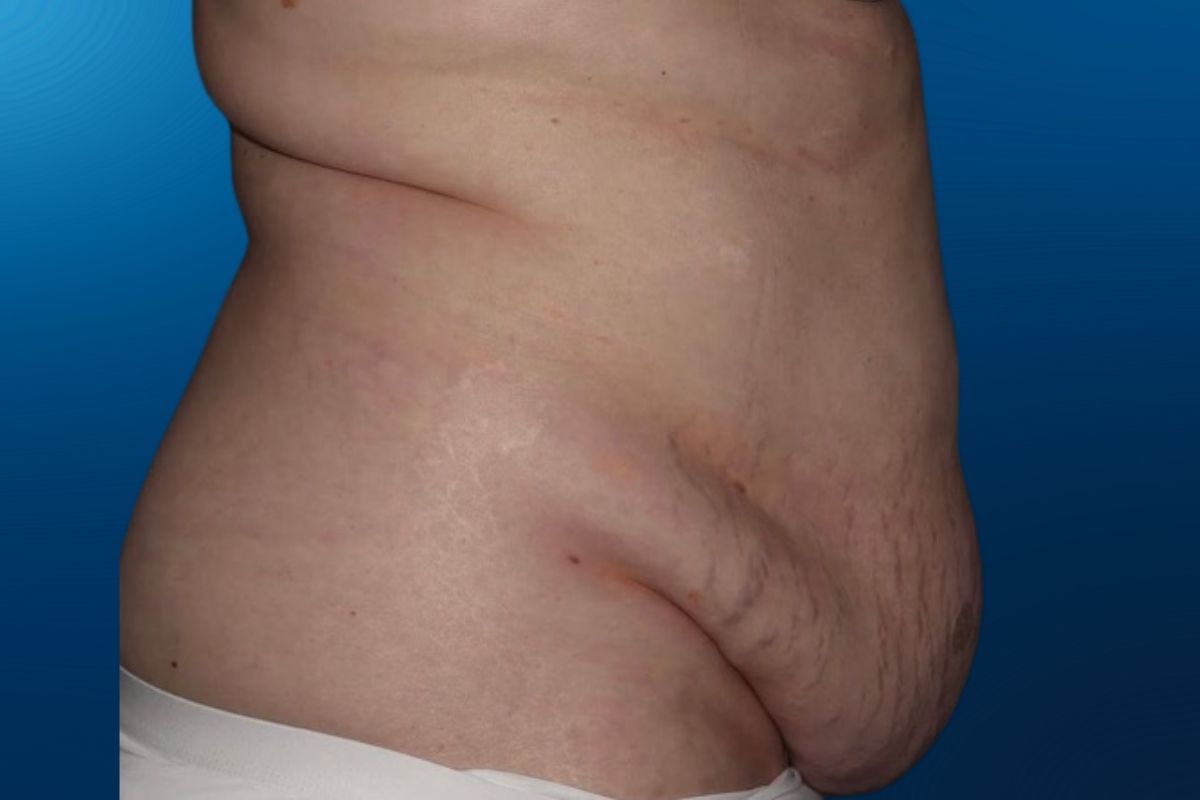 Abdominoplasty 13E