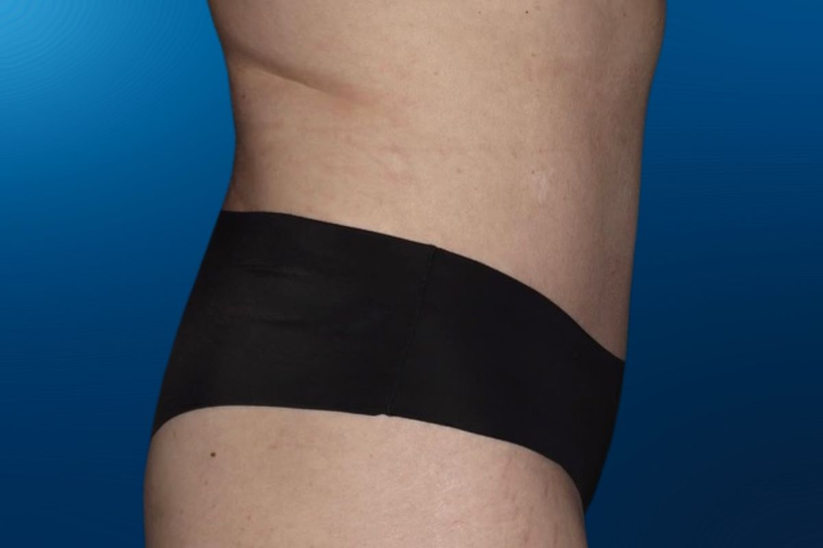 Abdominoplasty 13F