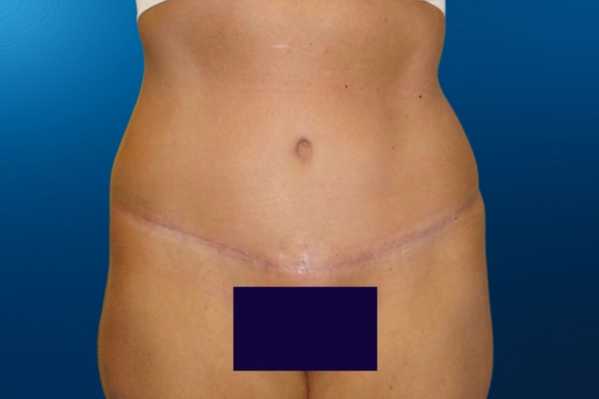 Abdominoplasty 1B