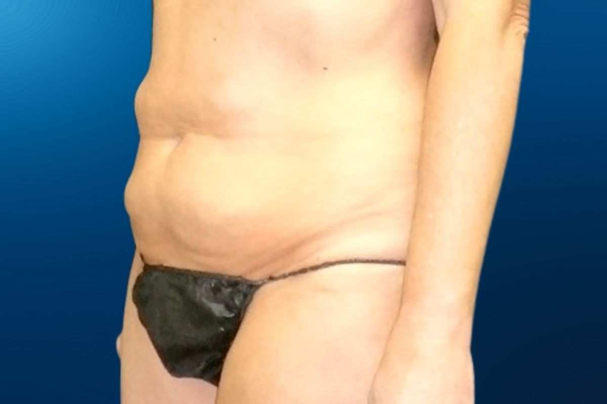 Abdominoplasty 1C