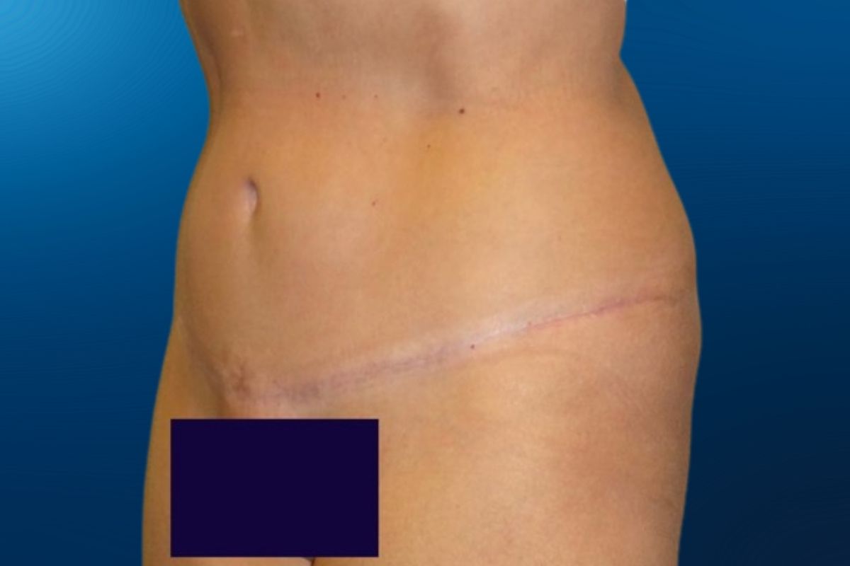 Abdominoplasty 1D