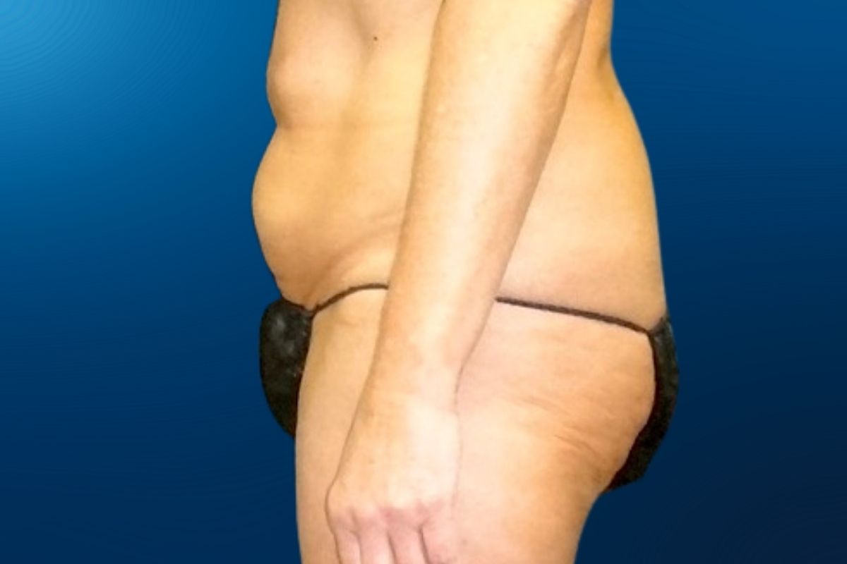 Abdominoplasty 1E