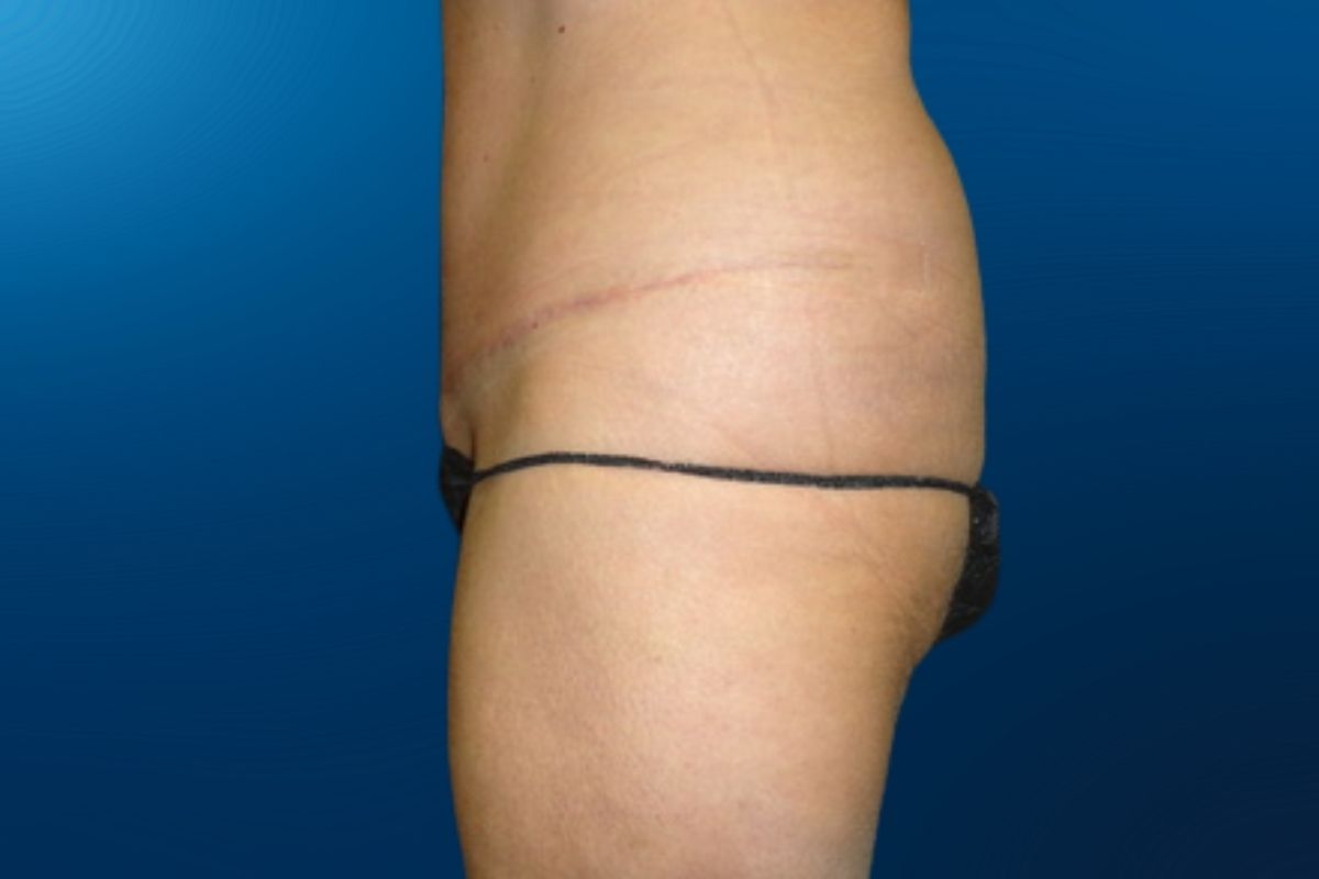 Abdominoplasty 1E (2)