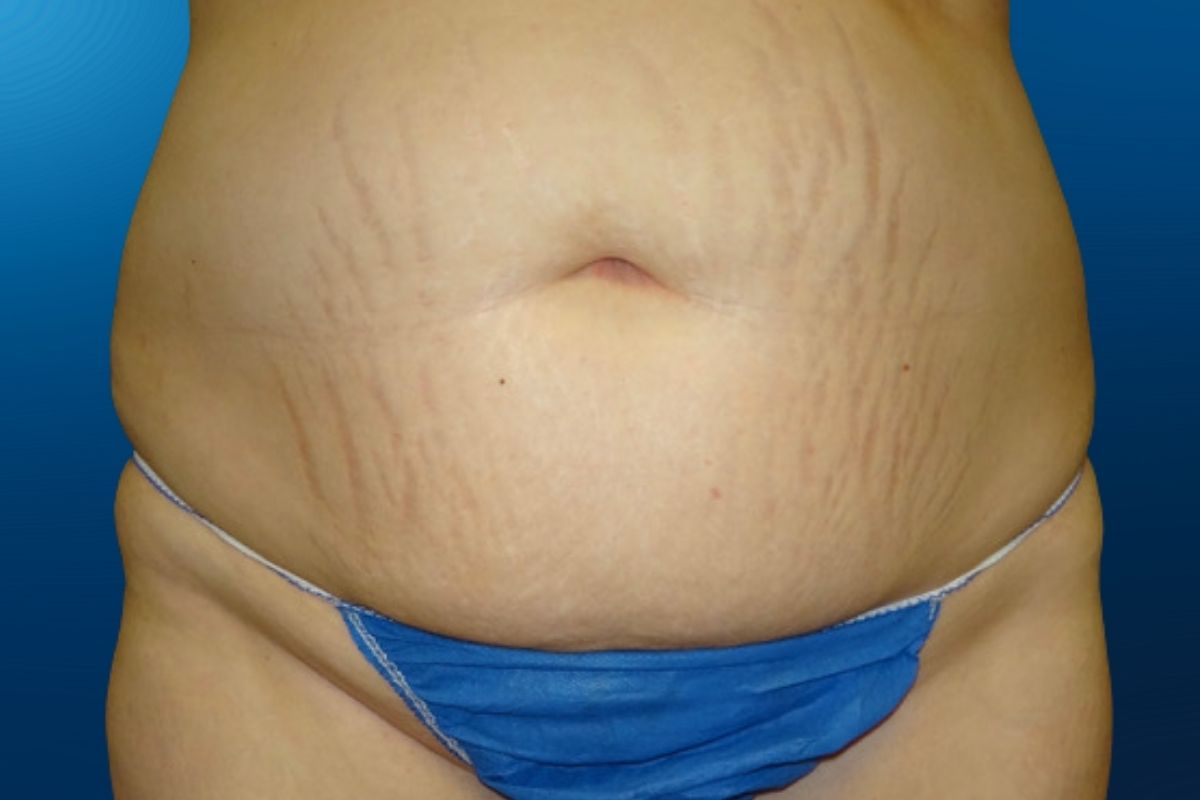 Abdominoplasty 2A