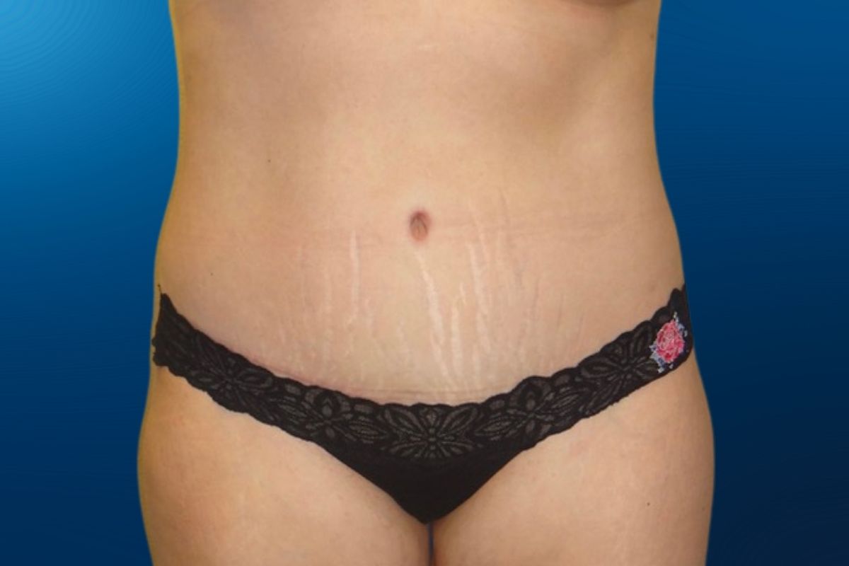 Abdominoplasty 2B