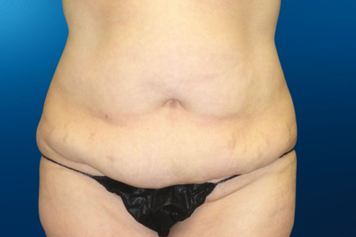 Abdominoplasty 3A