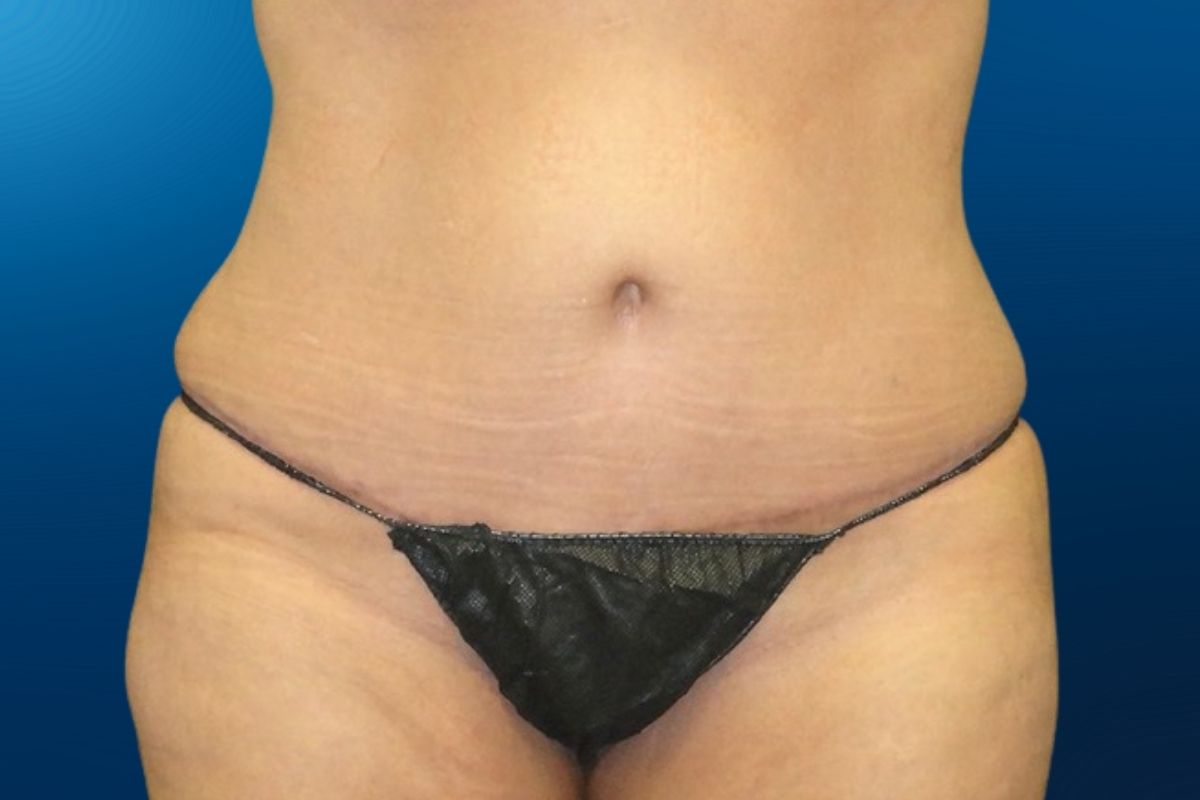 Abdominoplasty 3B