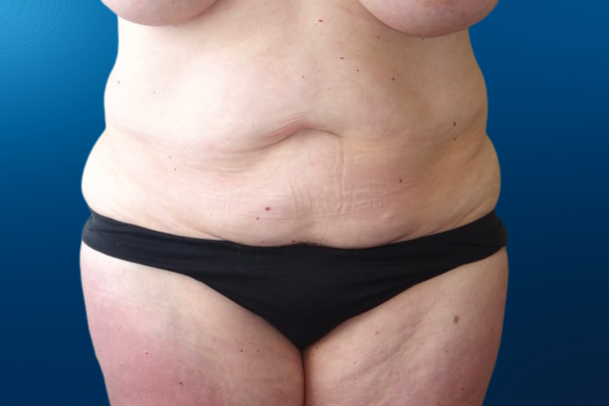 Abdominoplasty 4A