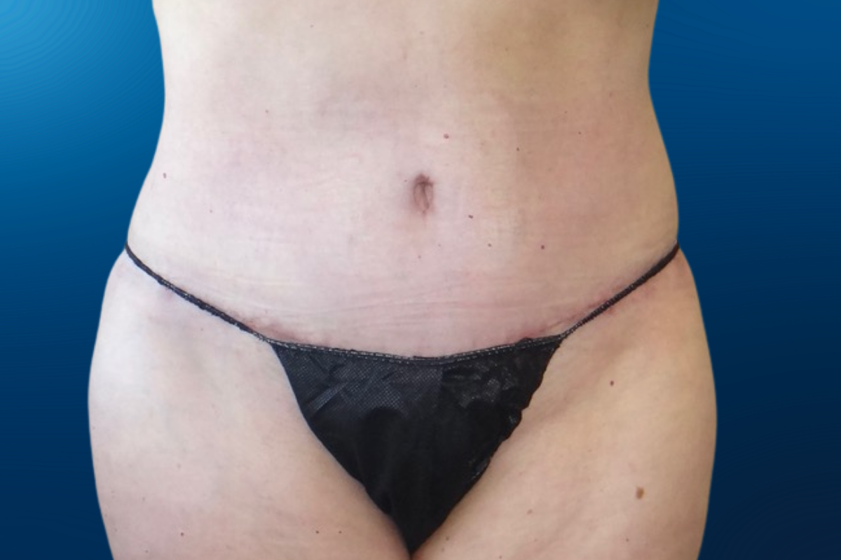 Abdominoplasty 4B