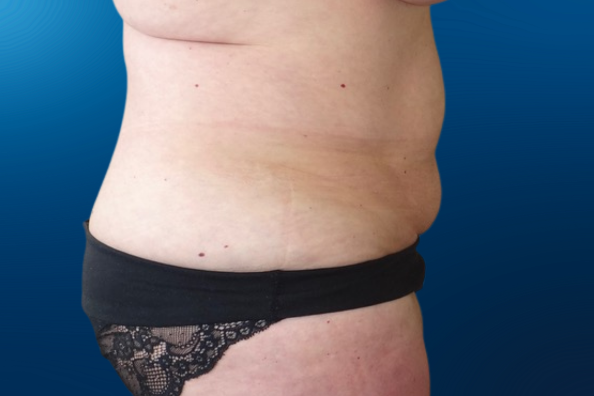 Abdominoplasty 4C