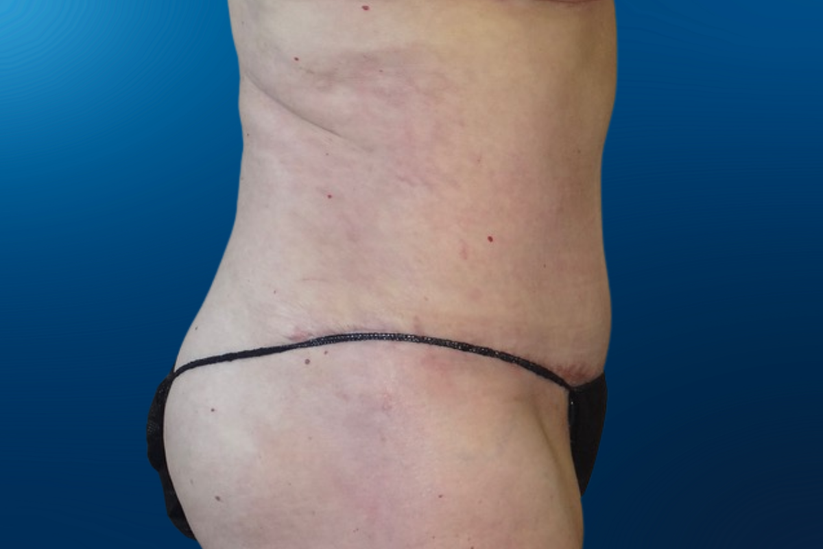 Abdominoplasty 4D