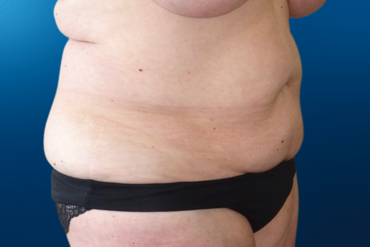 Abdominoplasty 4E